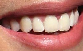 Picture of Sarah Butler teeth and smile