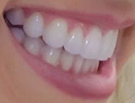 Picture of Savvy Shields teeth and smile