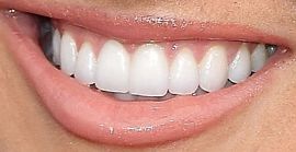 Picture of Savvy Shields teeth and smile