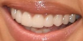 Scarlett Johansson's teeth