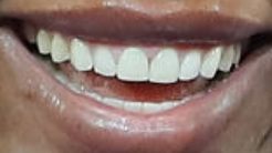 Serena Williams teeth and smile