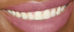 Serena Williams teeth