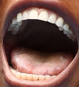 Serena Williams teeth