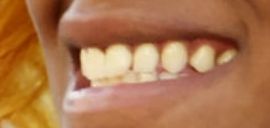 Picture of Sha'Carri Richardson teeth and smile