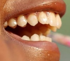 Picture of Sha'Carri Richardson teeth and smile
