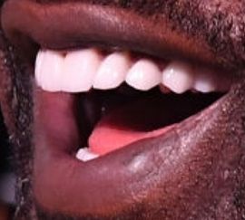 Picture of Shaquille O'Neal teeth and smile