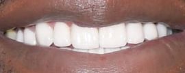 Picture of Shaquille O'Neal teeth and smile