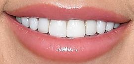 Picture of Sharna Burgess teeth and smile