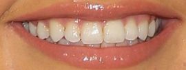Picture of Siena Agudong teeth and smile