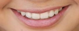 Picture of Siena Agudong teeth and smile