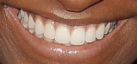 Picture of Simone Biles teeth and smile