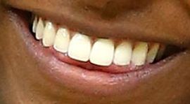 Picture of Simone Biles teeth and smile