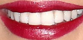 Picture of Cheryl Cole teeth and smile