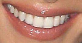 Picture of Cheryl Cole teeth and smile