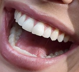 Picture of Stassi Schroeder teeth and smile