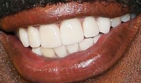 Picture of Steve Harvey teeth