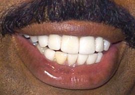 Picture of Steve Harvey teeth
