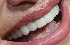 Picture of Suzanne Somers teeth and smile