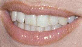 Picture of Suzanne Somers teeth and smile