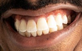 Picture of Tai Verdes teeth and smile