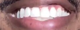 Picture of Tai Verdes teeth and smile