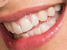 Picture of Tamara Ecclestone teeth and smile