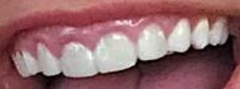 Picture of Tayler Holder teeth and smile