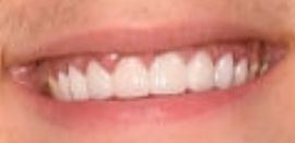 Picture of Tayler Holder teeth and smile