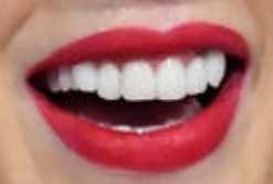 Taylor Swift's teeth