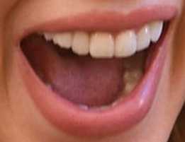 Taylor Swift's teeth
