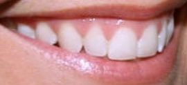 Picture of Terri Conn teeth and smile