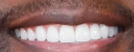 Terry Crews' teeth