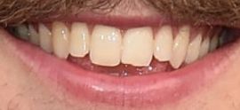 Picture of Thomas Rhett teeth and smile