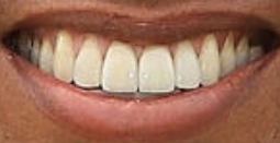 Picture of Tiger Woods teeth and smile