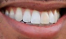 Picture of Tiger Woods teeth and smile