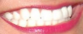 Picture of Tila Tequila teeth and smile