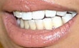 Picture of Tinashe teeth and smile