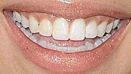 Picture of Tinashe teeth and smile