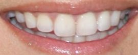 Picture of Tinsley Mortimer teeth and smile