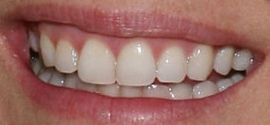 Picture of Tinsley Mortimer teeth and smile
