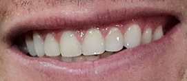 Tom Brady's teeth
