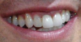 Picture of Tom Cruise's teeth while smiling