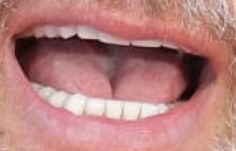Tom Hanks teeth