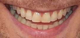 Picture of Tom Hiddleston teeth and smile