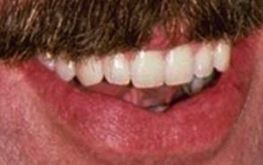 Picture of Tom Selleck teeth and smile