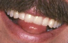 Picture of Tom Selleck teeth and smile