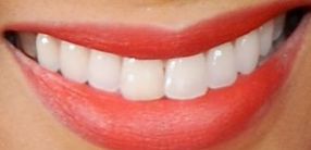 Picture of Tyra Banks teeth and smile
