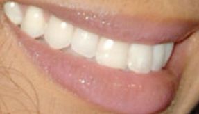 Picture of Tyra Banks teeth and smile