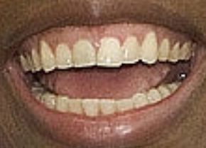 Picture of Venus Williams teeth and smile