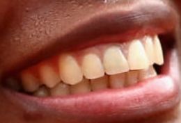 Picture of Venus Williams teeth and smile